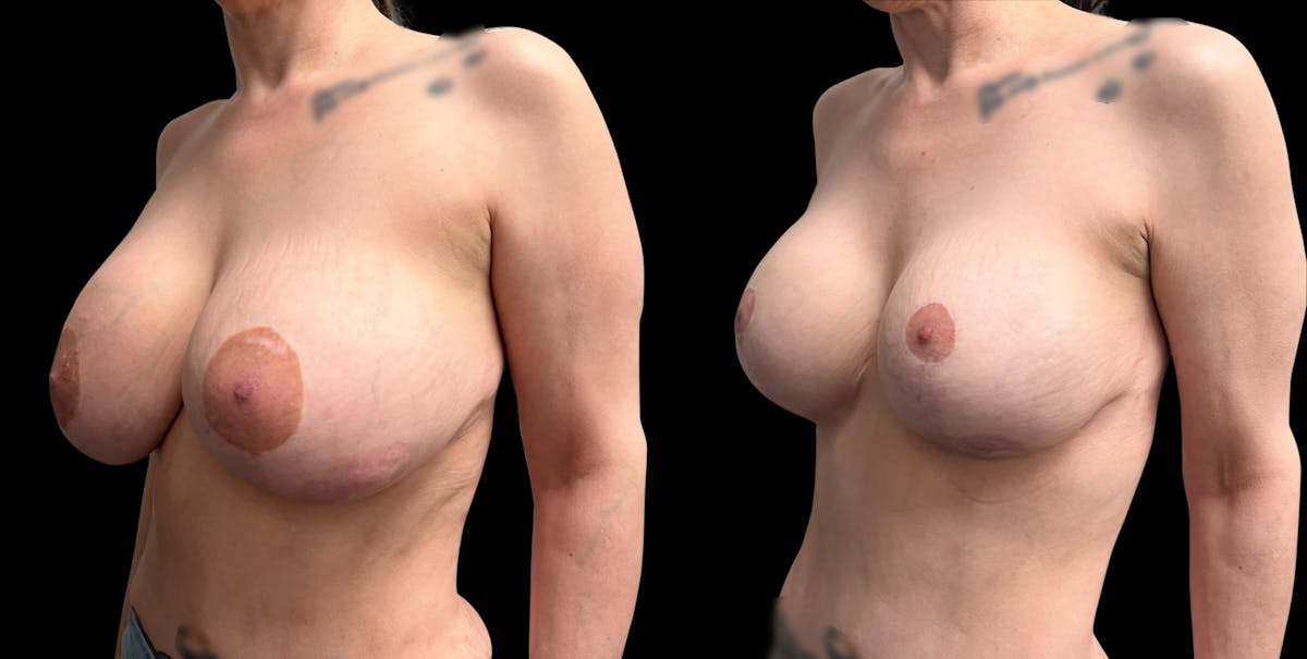 Breast Implant Exchange Before & After Gallery - Patient 808465 - Image 4