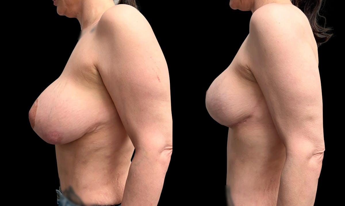 Breast Implant Exchange Before & After Gallery - Patient 808465 - Image 5