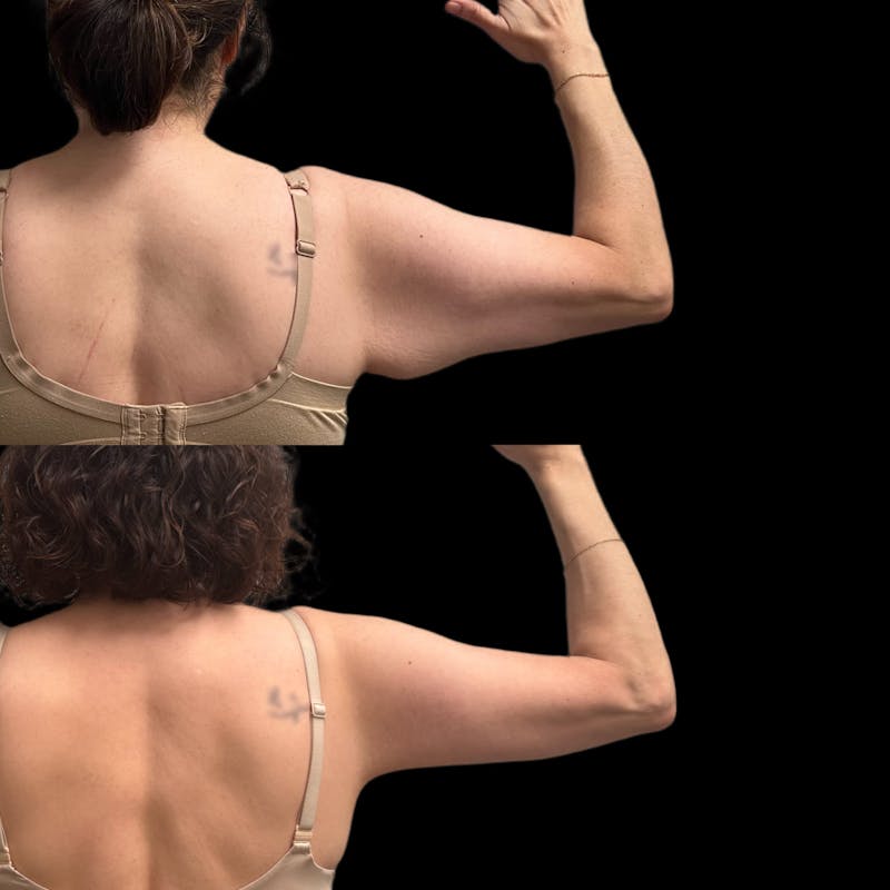 Arm Lift Before & After Gallery - Patient 916316 - Image 1