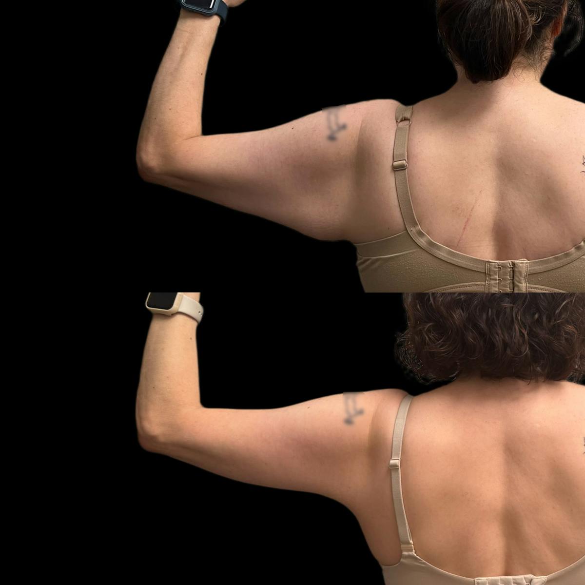 Arm Lift Before & After Gallery - Patient 916316 - Image 2
