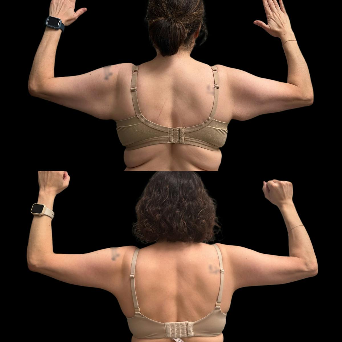 Arm Lift Before & After Gallery - Patient 916316 - Image 3