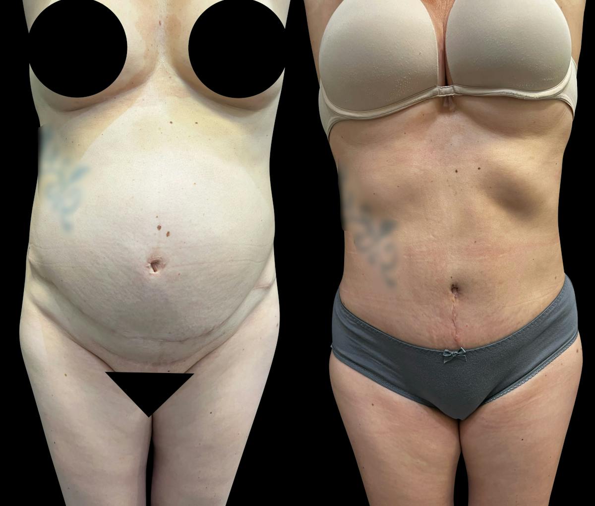 Tummy Tuck Before & After Gallery - Patient 136401 - Image 1