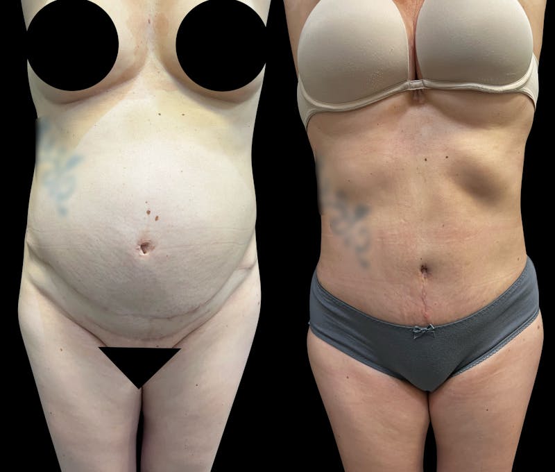 Tummy Tuck Before & After Gallery - Patient 136401 - Image 1