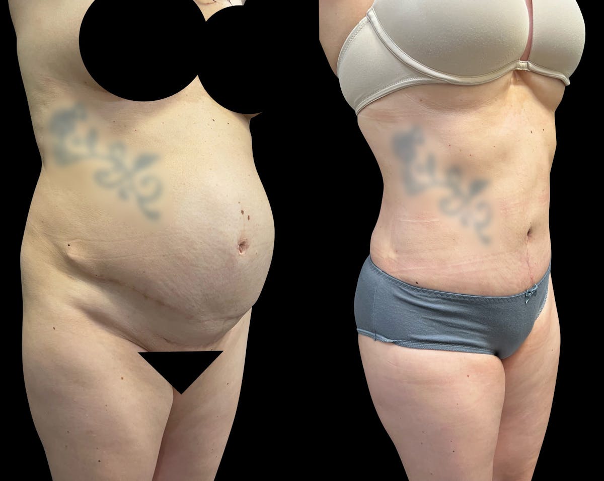 Tummy Tuck Before & After Gallery - Patient 136401 - Image 2