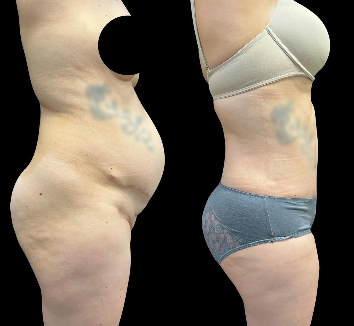 Tummy Tuck Before & After Gallery - Patient 136401 - Image 3