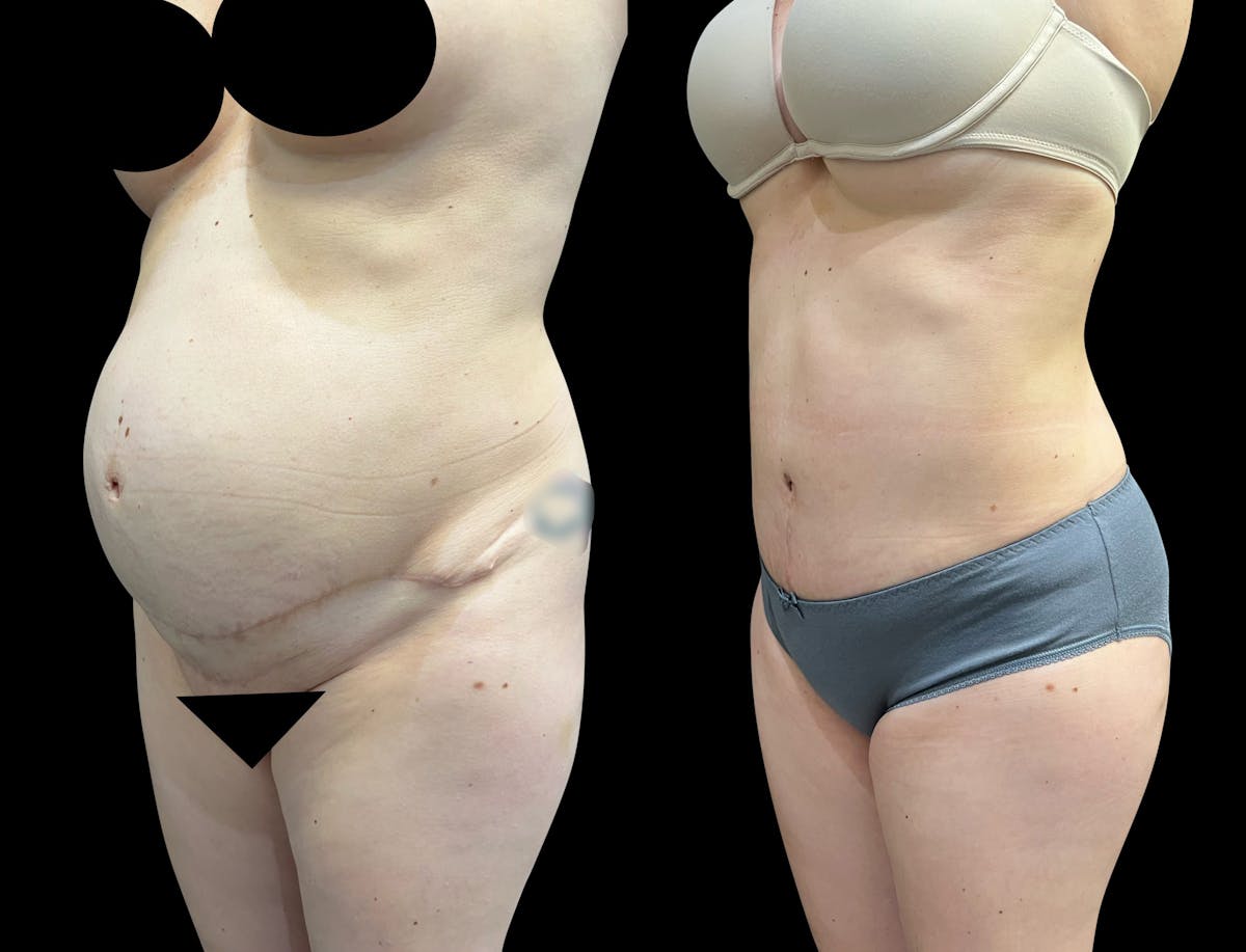 Tummy Tuck Before & After Gallery - Patient 136401 - Image 4
