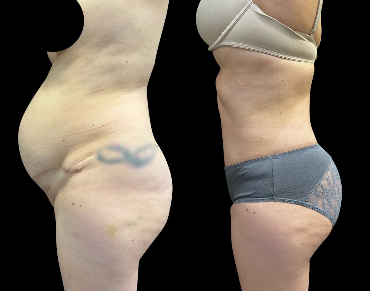 Tummy Tuck Before & After Gallery - Patient 136401 - Image 5
