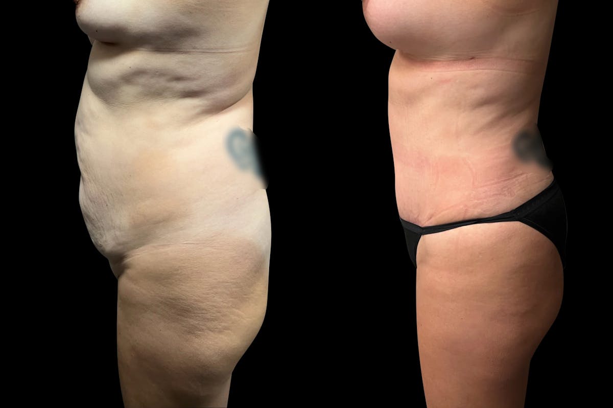 Tummy Tuck Before & After Gallery - Patient 322332 - Image 1