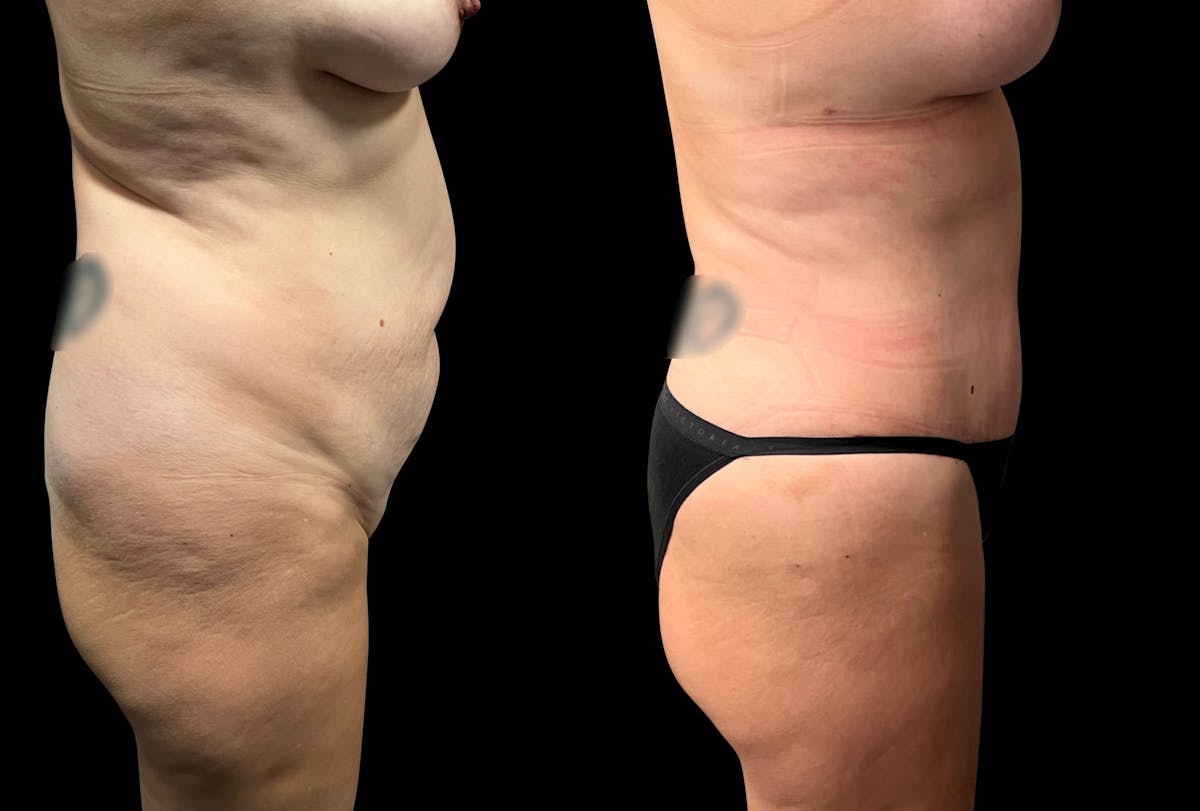 Tummy Tuck Before & After Gallery - Patient 322332 - Image 2