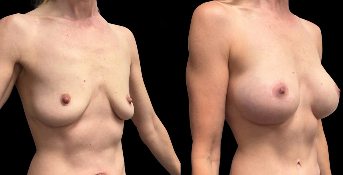Breast Augmentation with Lift Before & After Gallery - Patient 257243 - Image 2