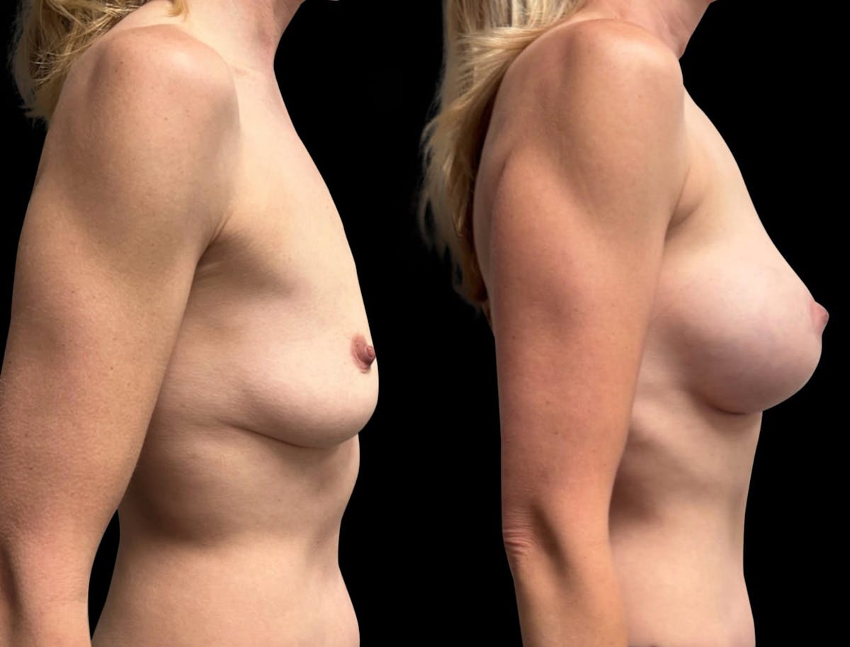 Breast Augmentation with Lift Before & After Gallery - Patient 257243 - Image 3