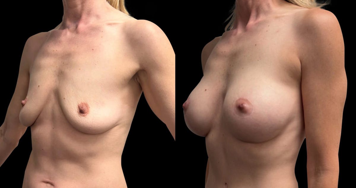 Breast Augmentation with Lift Before & After Gallery - Patient 257243 - Image 4