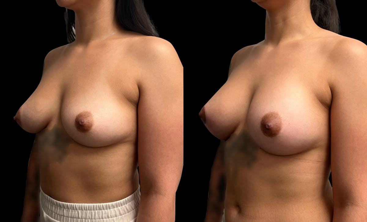 Breast Augmentation with Lift Before & After Gallery - Patient 331430 - Image 4