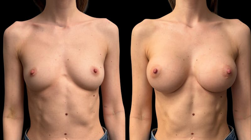 Breast Augmentation Before & After Gallery - Patient 444663 - Image 1