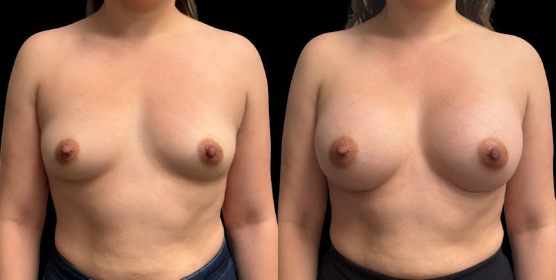 Breast Augmentation Before & After Gallery - Patient 189269 - Image 1