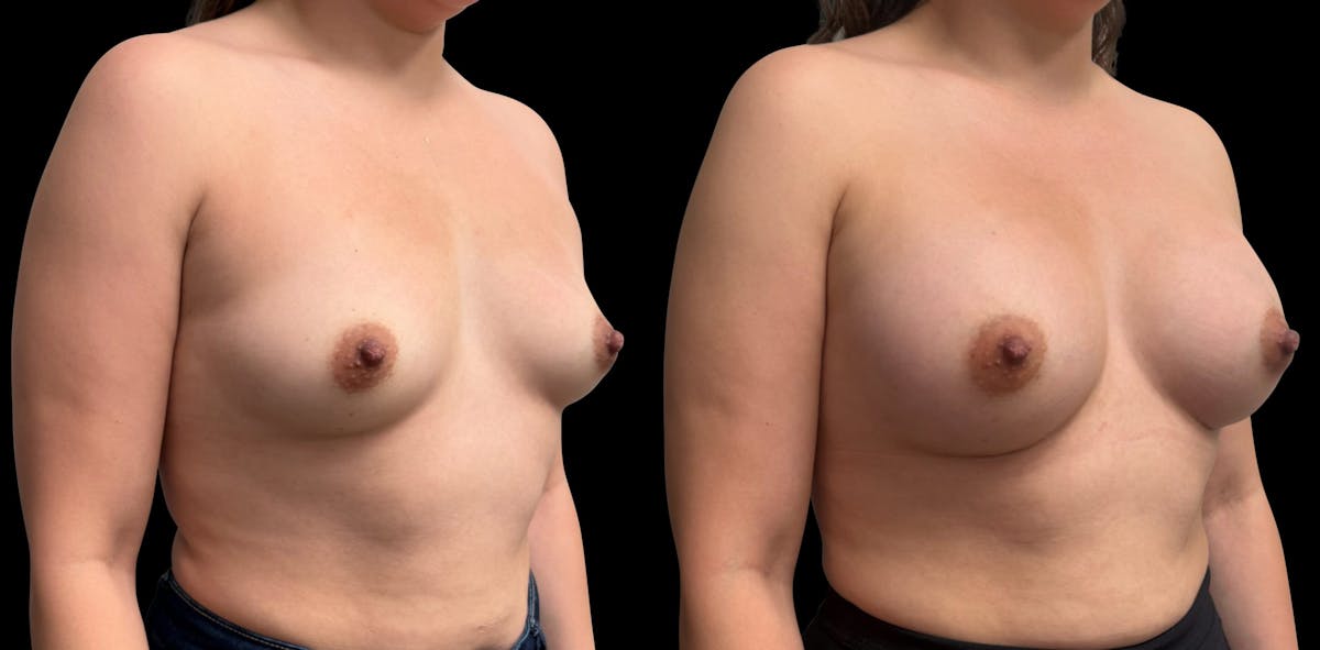 Breast Augmentation Before & After Gallery - Patient 189269 - Image 2