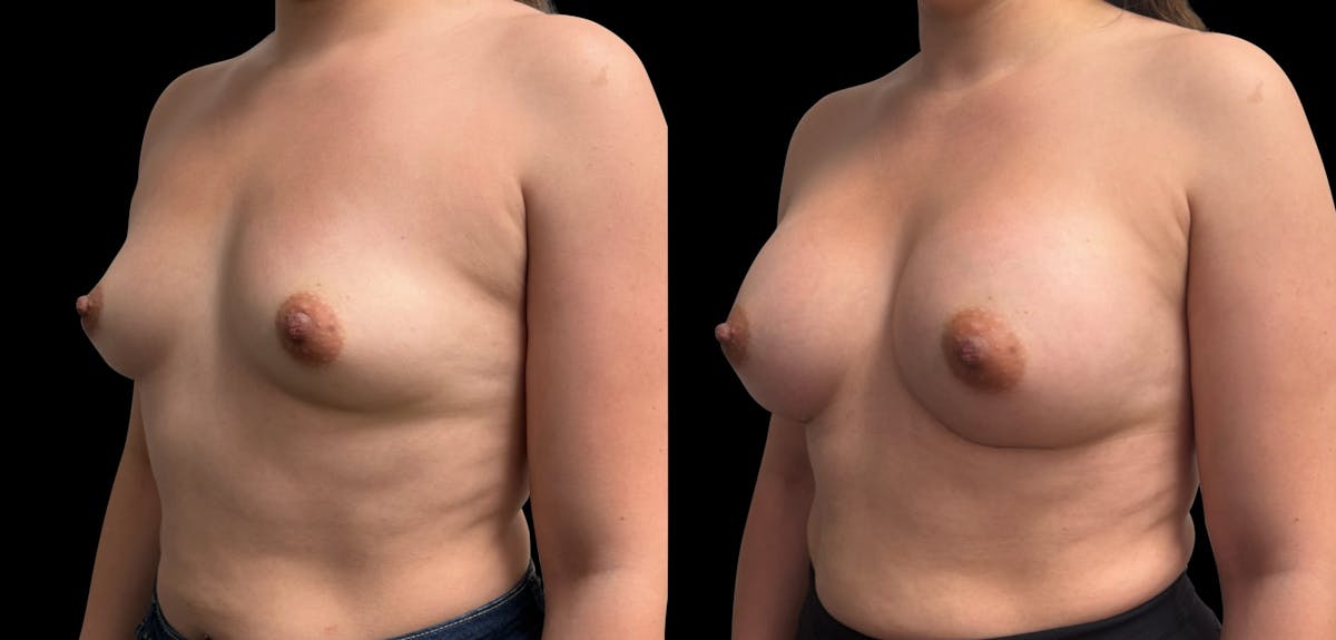 Breast Augmentation Before & After Gallery - Patient 189269 - Image 4