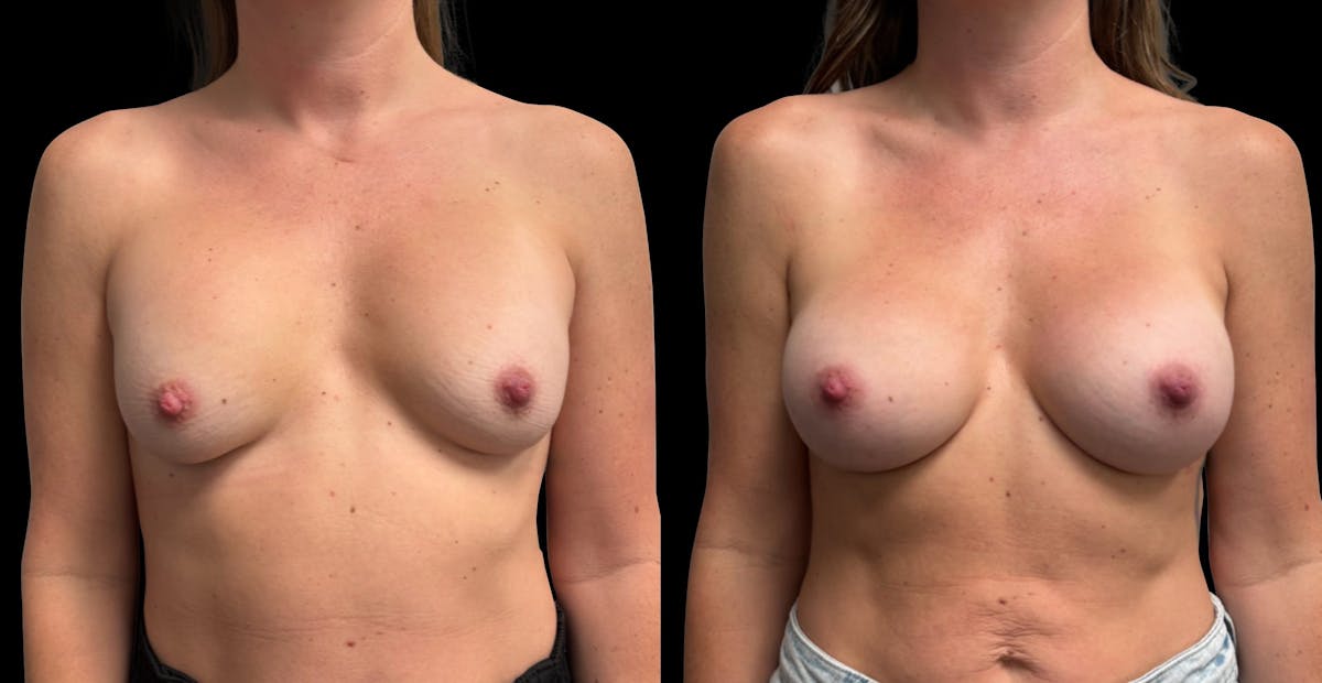 Breast Implant Exchange Before & After Gallery - Patient 247340 - Image 1