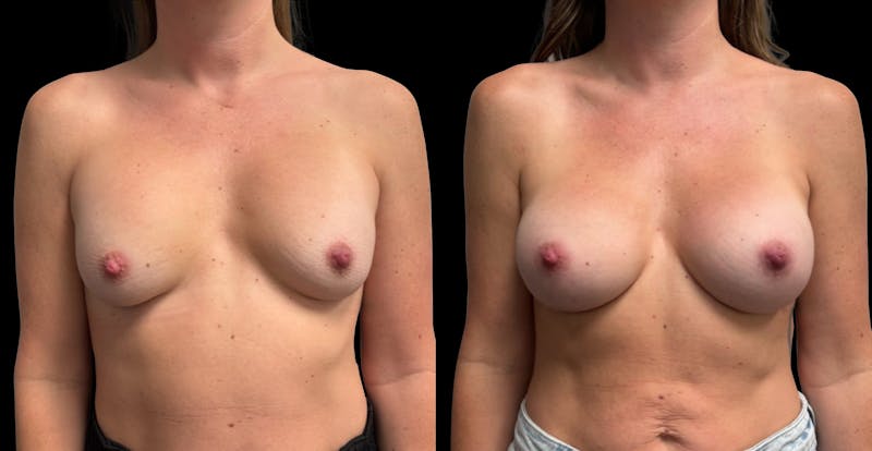 Breast Implant Exchange Before & After Gallery - Patient 247340 - Image 1