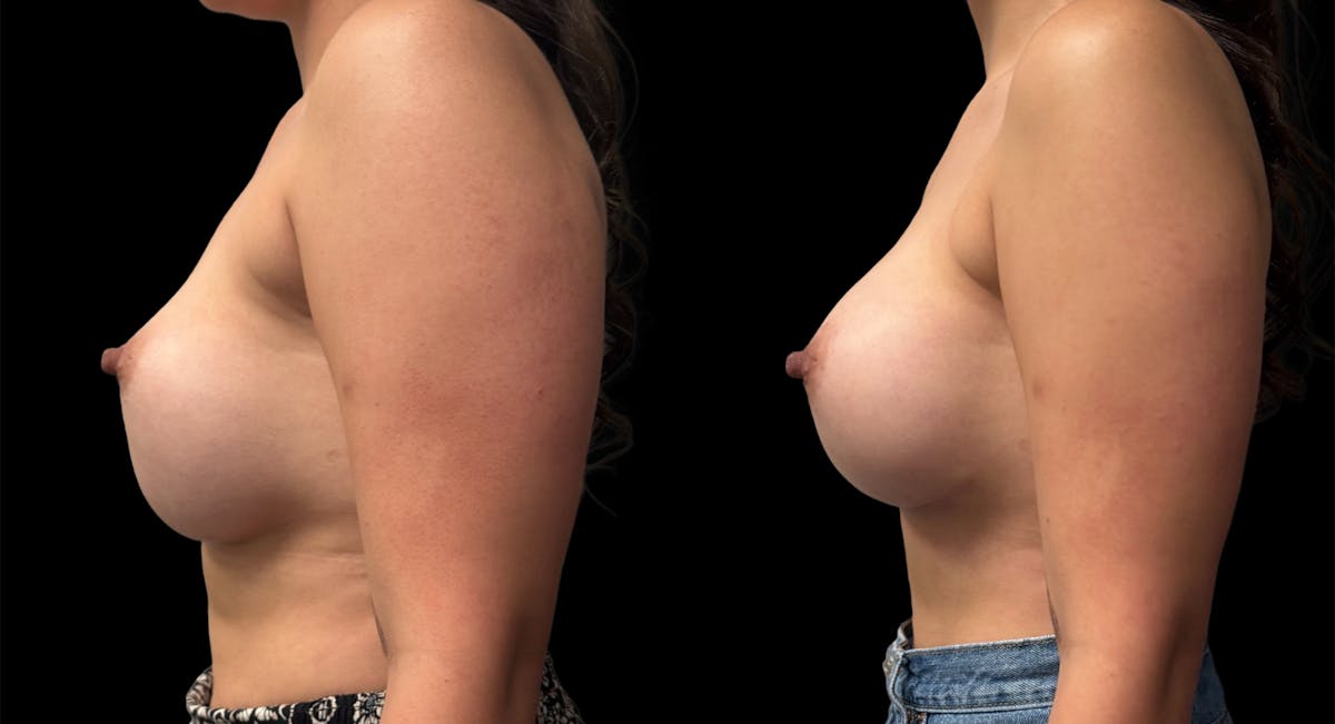 Breast Implant Exchange Before & After Gallery - Patient 426090 - Image 2