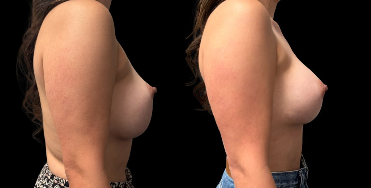 Breast Implant Exchange Before & After Gallery - Patient 426090 - Image 4