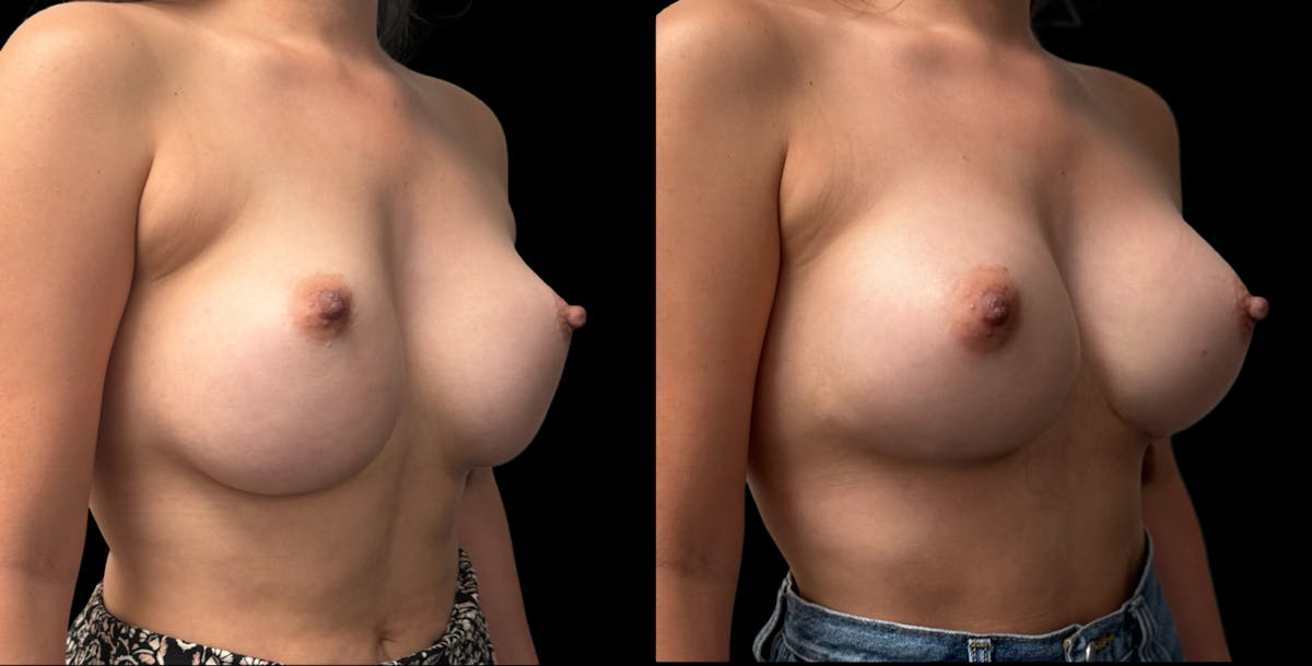 Breast Implant Exchange Before & After Gallery - Patient 426090 - Image 3