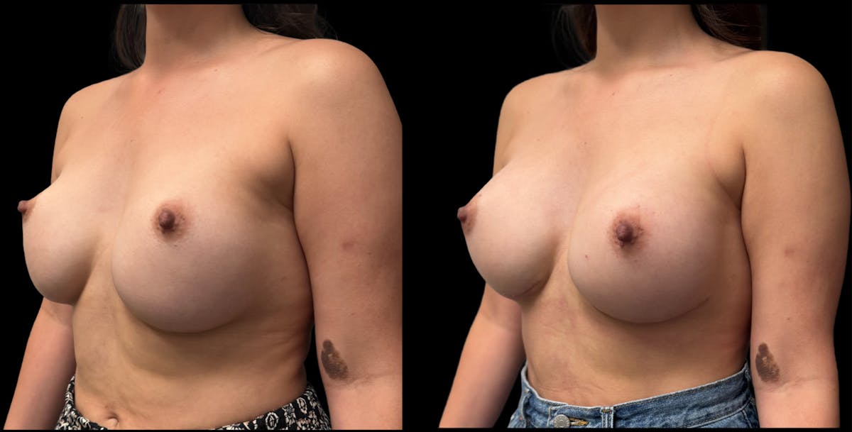 Breast Implant Exchange Before & After Gallery - Patient 426090 - Image 1