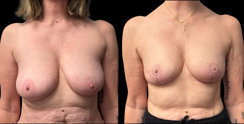 Breast Reduction Before & After Gallery - Patient 830684 - Image 1