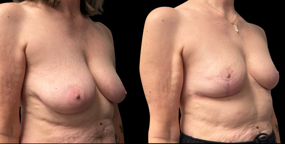 Breast Reduction Before & After Gallery - Patient 830684 - Image 2