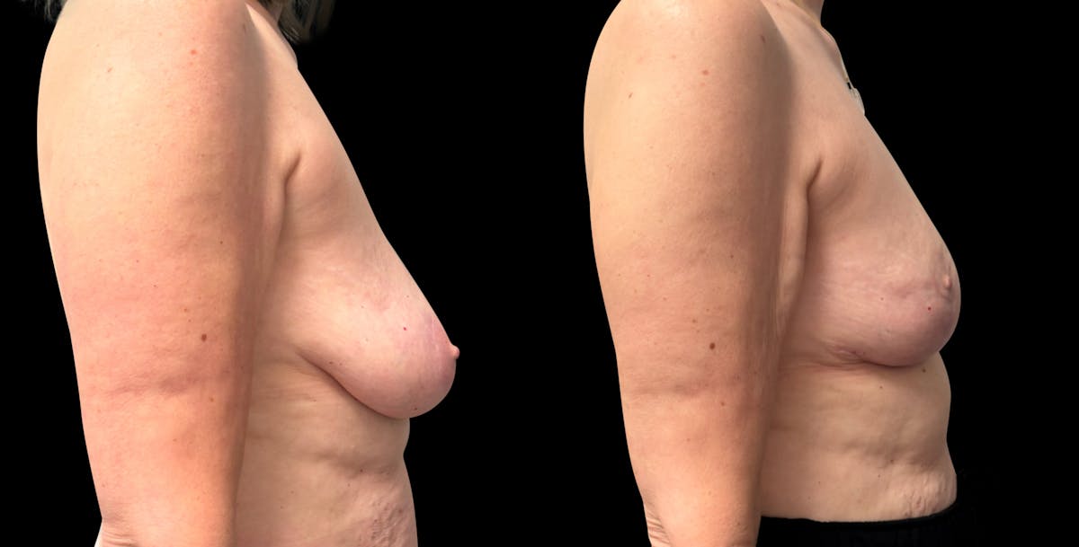 Breast Reduction Before & After Gallery - Patient 830684 - Image 3