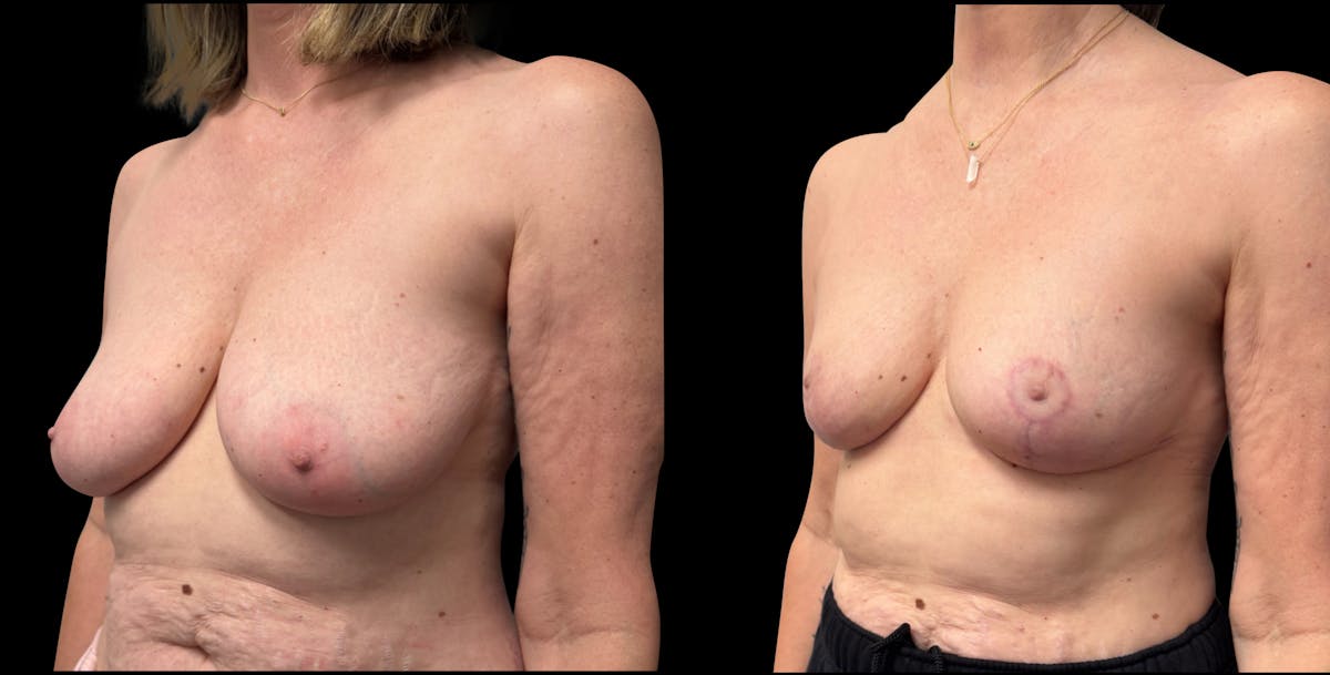 Breast Reduction Before & After Gallery - Patient 830684 - Image 4