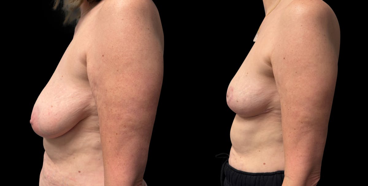Breast Reduction Before & After Gallery - Patient 830684 - Image 5