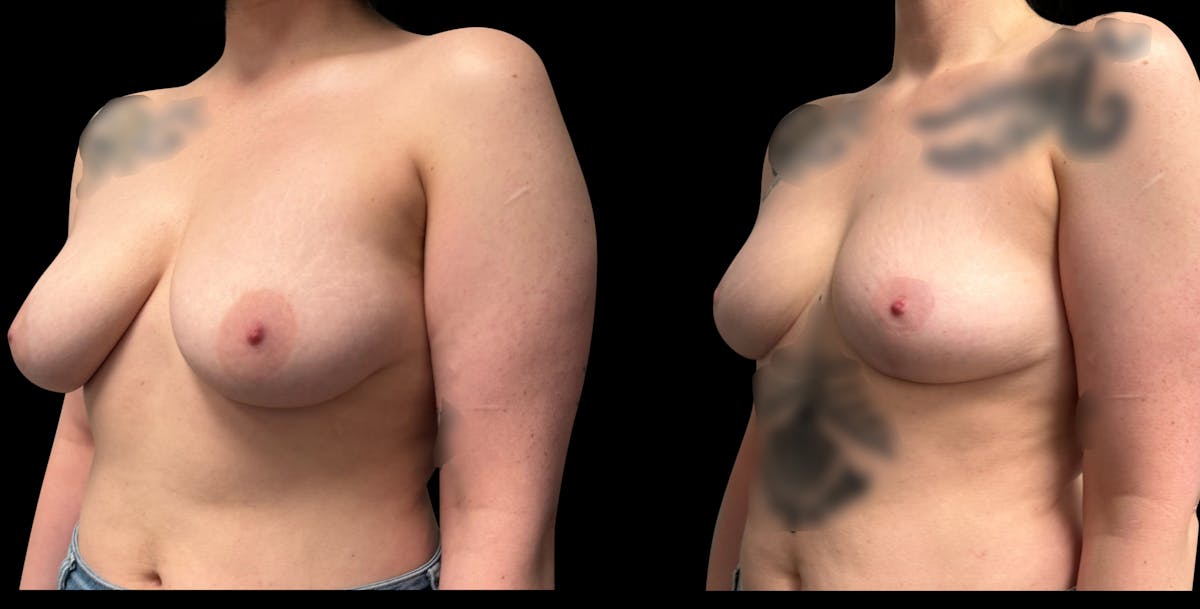 Breast Reduction Before & After Gallery - Patient 835468 - Image 2