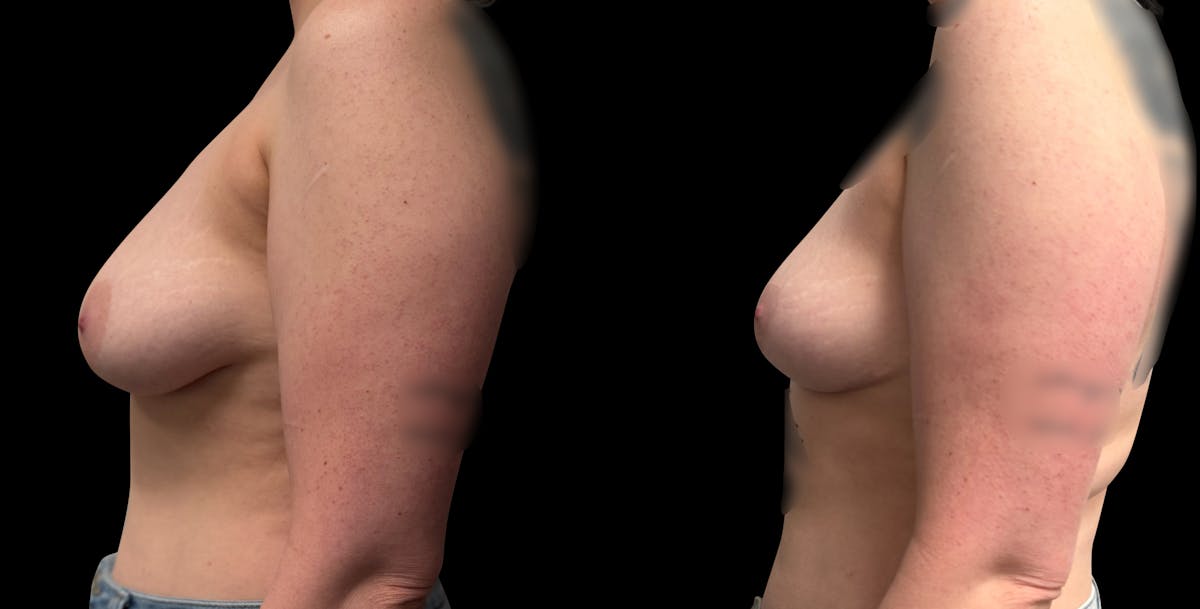 Breast Reduction Before & After Gallery - Patient 835468 - Image 3