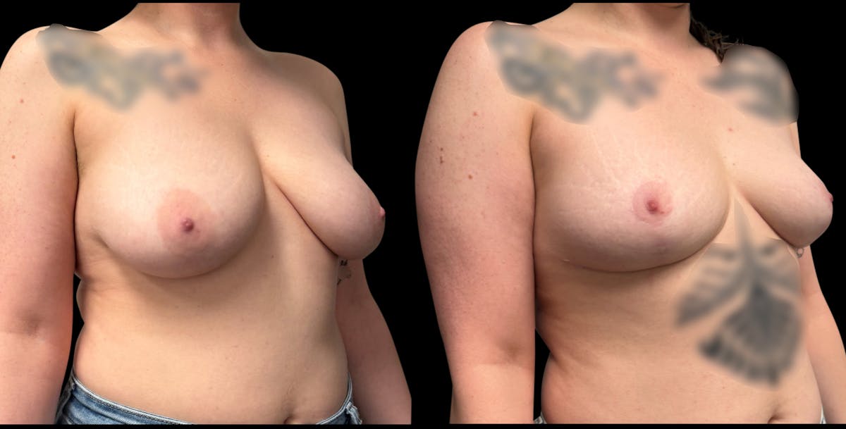 Breast Reduction Before & After Gallery - Patient 835468 - Image 4