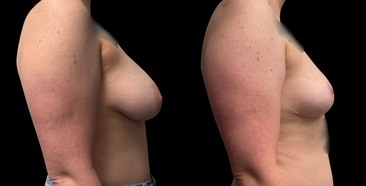 Breast Reduction Before & After Gallery - Patient 835468 - Image 5