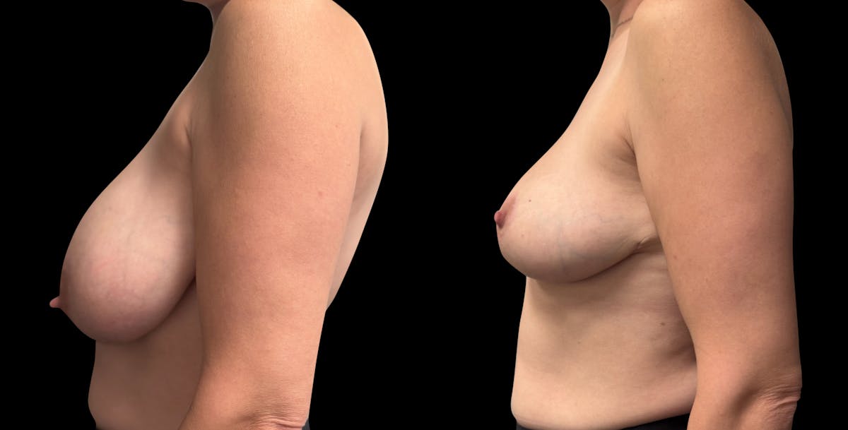 Breast Reduction Before & After Gallery - Patient 247713 - Image 3