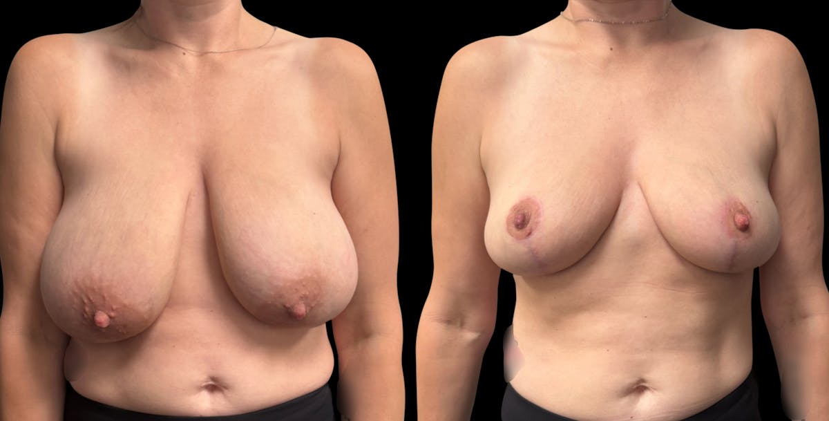 Breast Reduction Before & After Gallery - Patient 247713 - Image 1