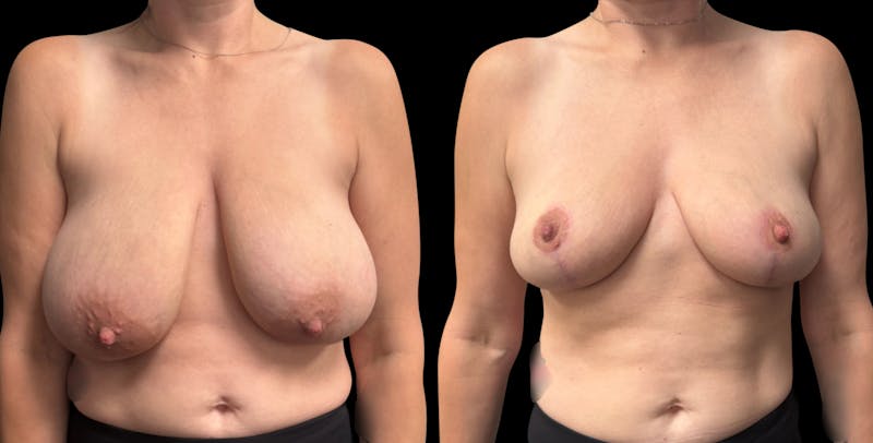 Breast Reduction Before & After Gallery - Patient 247713 - Image 1