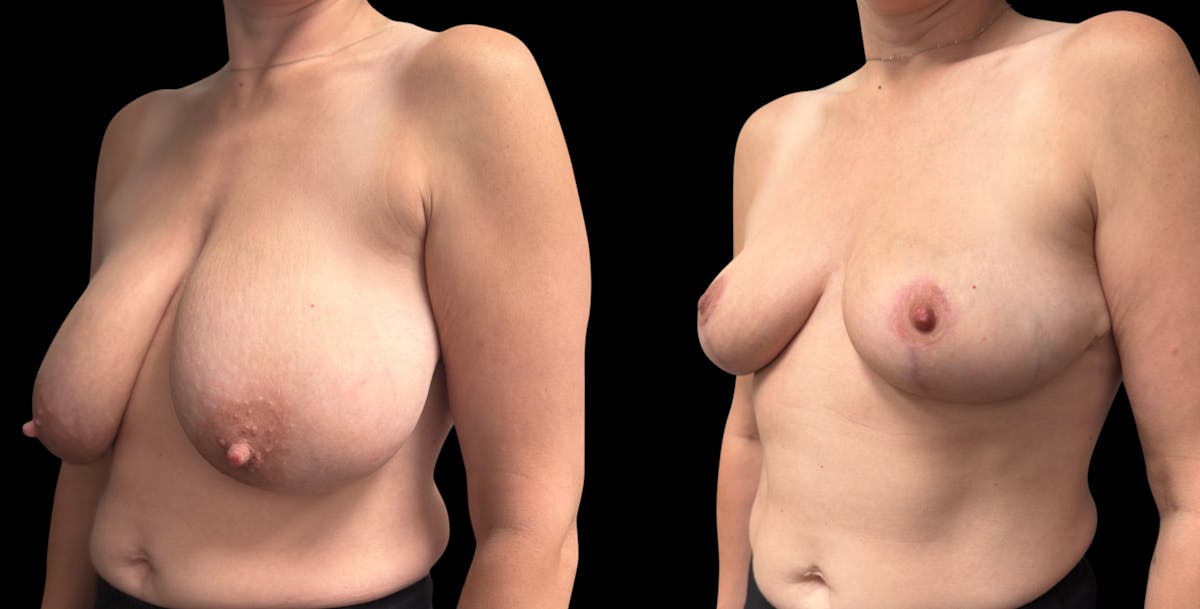 Breast Reduction Before & After Gallery - Patient 247713 - Image 2