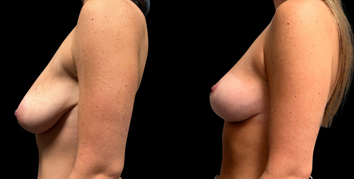 Breast Reduction Before & After Gallery - Patient 326237 - Image 5