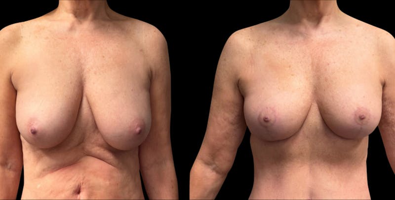 Breast Reduction Before & After Gallery - Patient 240042 - Image 1