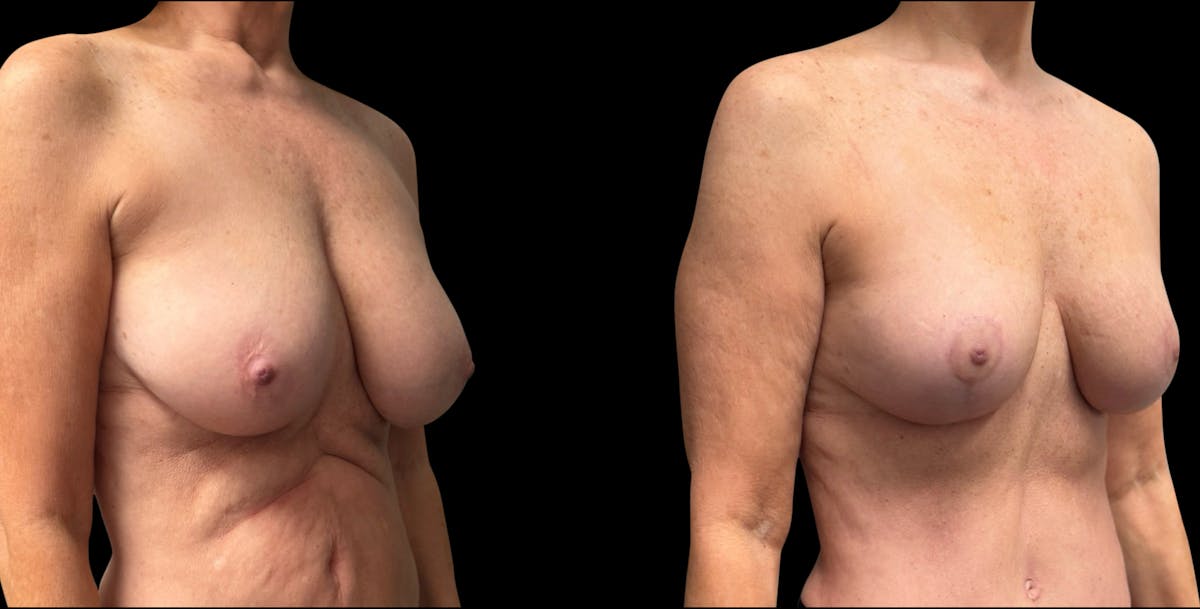 Breast Reduction Before & After Gallery - Patient 240042 - Image 4