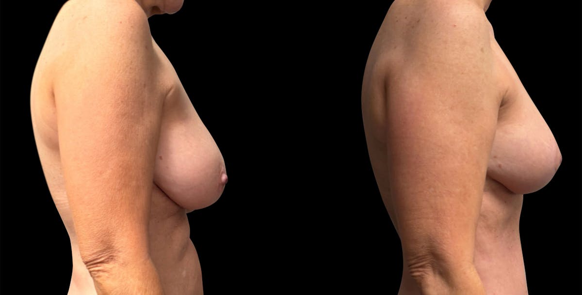 Breast Reduction Before & After Gallery - Patient 240042 - Image 5