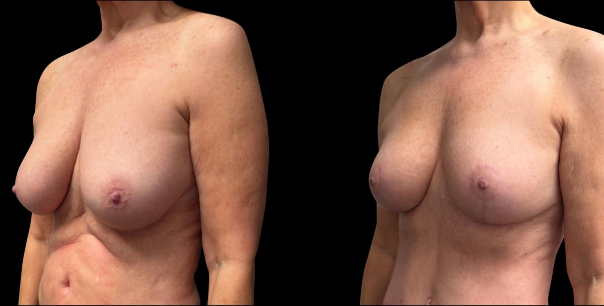 Breast Reduction Before & After Gallery - Patient 240042 - Image 2