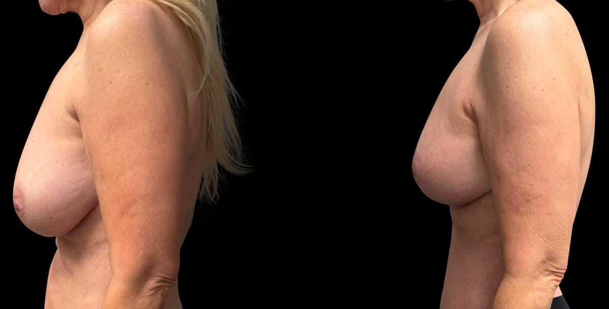 Breast Reduction Before & After Gallery - Patient 240042 - Image 3