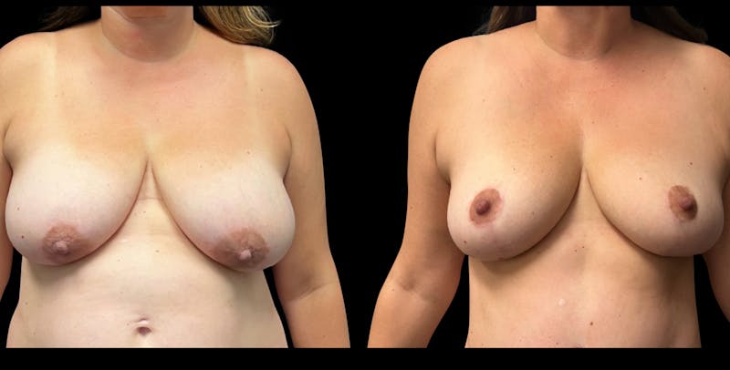Breast Reduction Before & After Gallery - Patient 333484 - Image 1