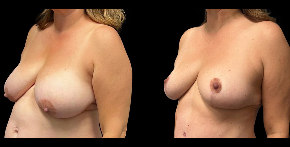 Breast Reduction Before & After Gallery - Patient 333484 - Image 4