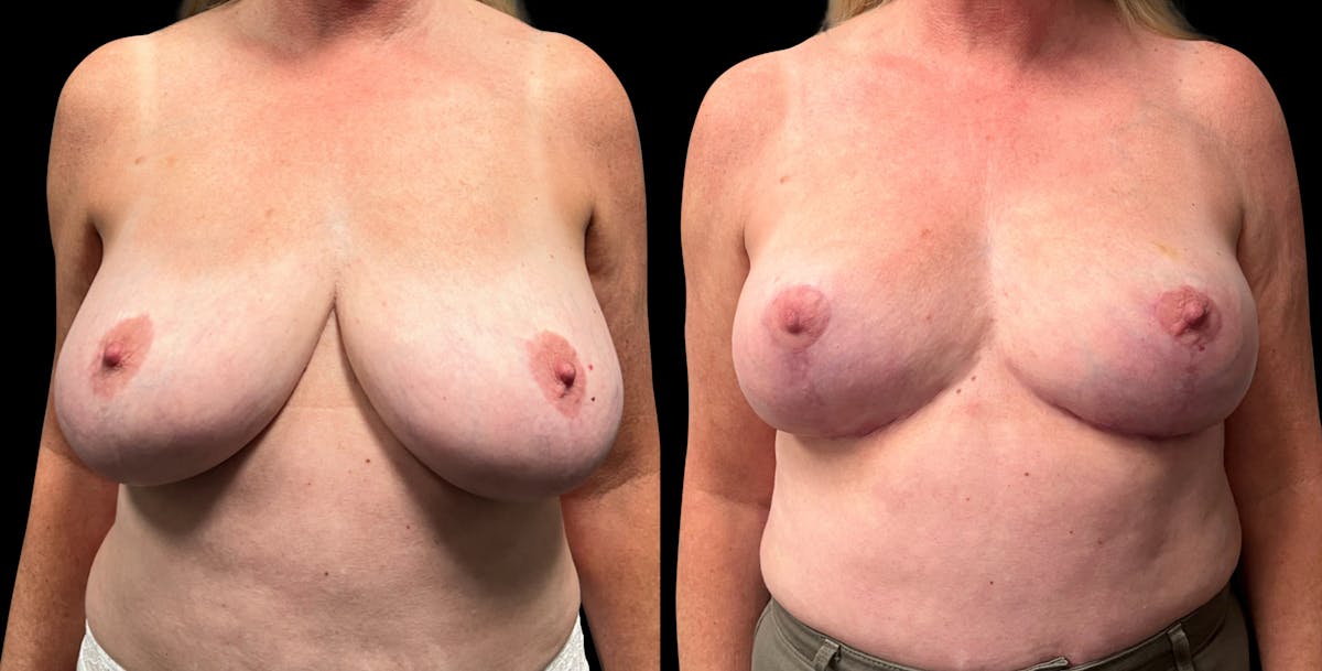 Breast Reduction Before & After Gallery - Patient 799702 - Image 1