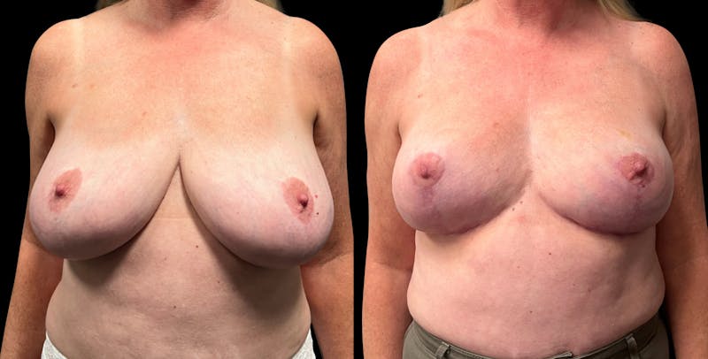 Breast Reduction Before & After Gallery - Patient 799702 - Image 1